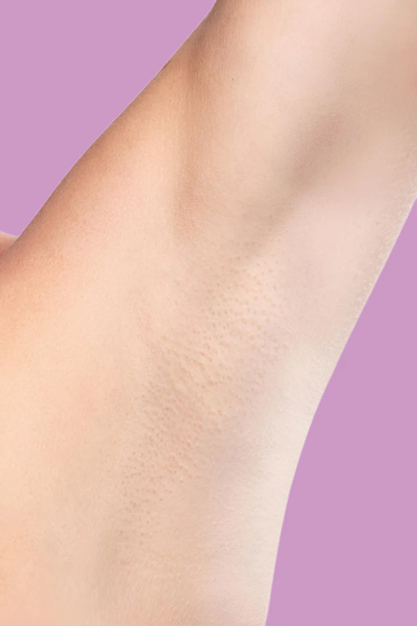 Kućni IPL Epilator – Trajno Uklanjanje Dlake